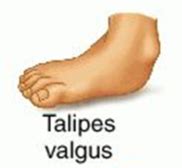 Valgus - Definition and Examples - Biology Online Dictionary