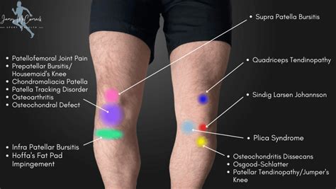 Knee Pain Location Chart | Learn the Pain Location of Knee Injuries