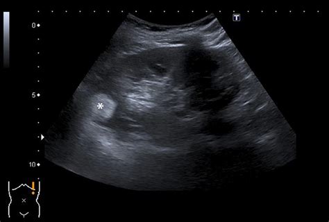 Kidney Tumor Ultrasound