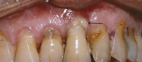 Pyorrhea Is Gum Disease We All Should Know About - Destination Dental Care