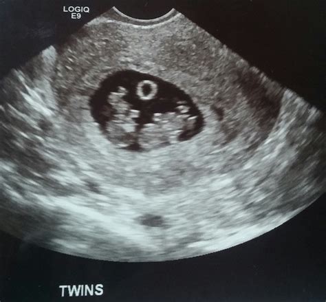 The Twins First Trimester Checklist - Twiniversity