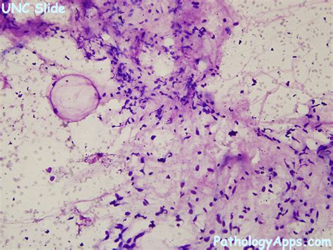 myxoid liposarcoma soft tissue cytology