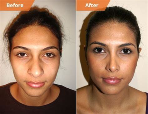 rhinoplasty after injury - Yahoo Search Results | Nose job, Rhinoplasty, Rhinoplasty before and ...