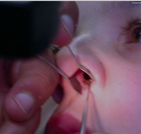 What is nasal cautery? — ent4kids