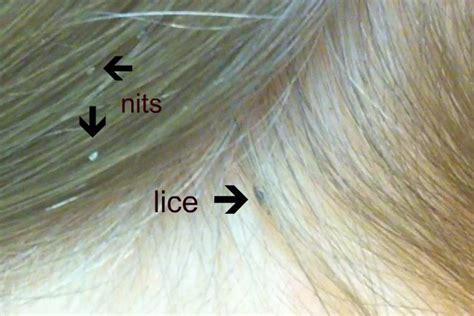 Nits and head lice: a parent's guide - Netmums