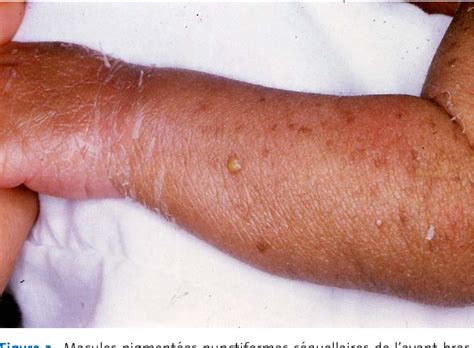 Figure 3 from [Transient pustular eruption in neonates]. | Semantic Scholar