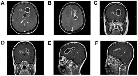 Causes of lesions in the brain: Brain Lesions: Causes, Symptoms ...