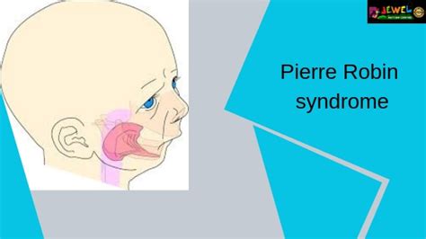 Pierre Robin syndrome | Autism treatment centre | India