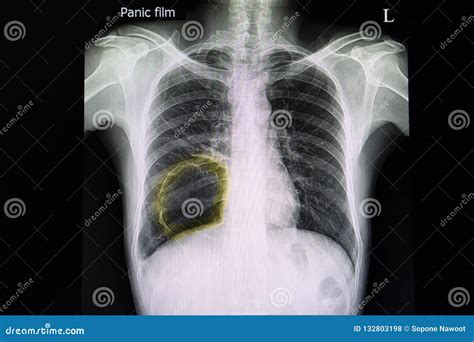 Lung bleb stock photo. Image of anatomy, marker, marks - 132803198