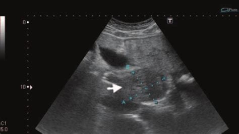 Normal Liver Ultrasound