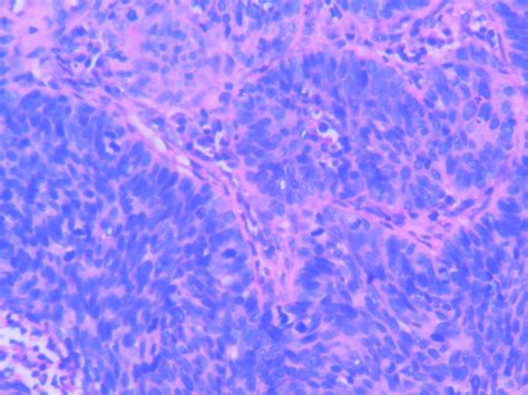 BASALOID SQUAMOUS CELL CARCINOMA – Histopathology.guru