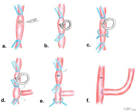 Carotid Subclavian Transposition