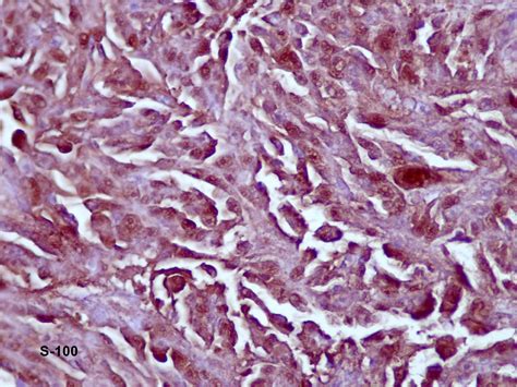 Clear Cell Sarcoma (Melanoma of Soft Parts)