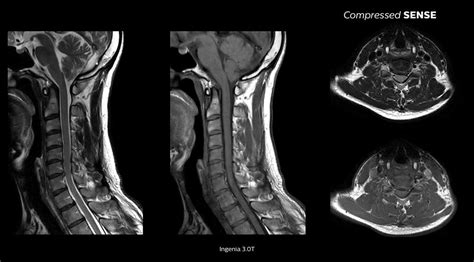 MRI Compressed Sensing - MRI software | Philips