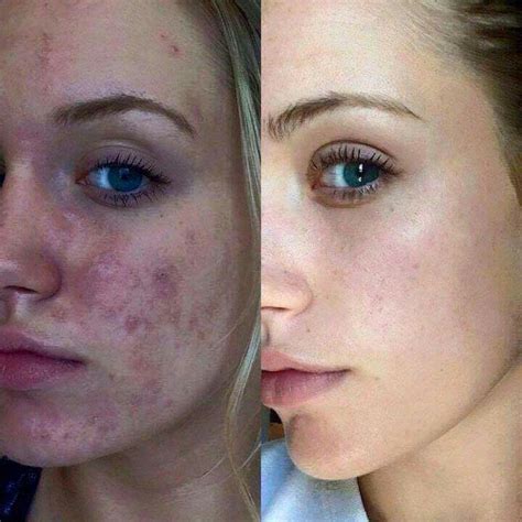 adapalene acne scars before after - Nicholas Watkins