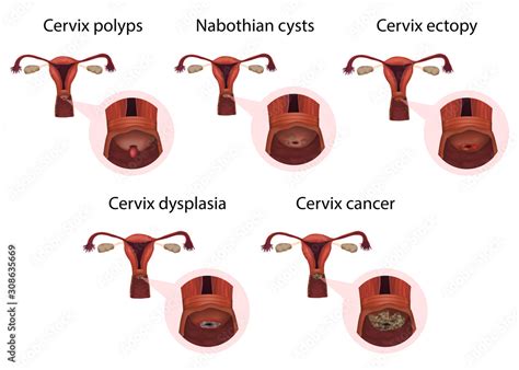 Cervical diseases. Cervix polyps, ectopy, dysplasia, cancer, nabothian ...