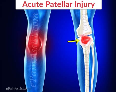 Acute Patellar Injury Read: http://www.epainassist.com/sports-injuries ...