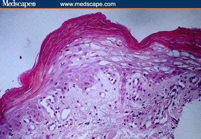 Necrolytic Migratory Erythema