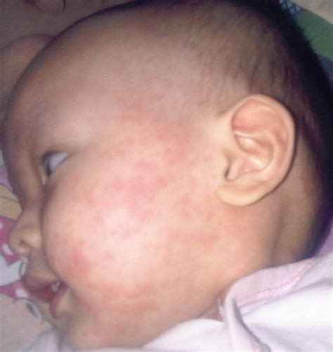 Dengue Fever Rash