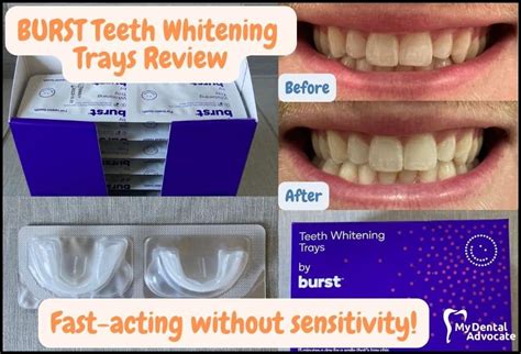 BURST Teeth Whitening Trays Review & Promo Code 2023 | MDA