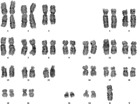 Karyotype of a patient with Turner syndrome | Download Scientific Diagram