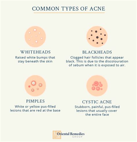 Understanding and treating acne, maskne, back acne the TCM way - Oriental Remedies Group