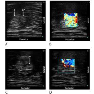 A, C After perineural catheter placement, ultrasound images displaying... | Download Scientific ...