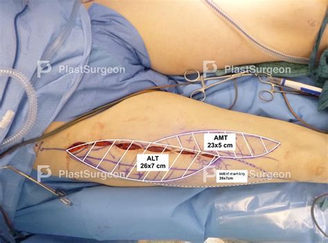 Case 19: Pushing the Limits of Lower Extremity Reconstruction: A Free Conjoined ALT and AMT Flap ...