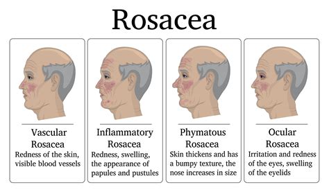 Mild Rosacea Nose