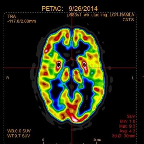 PET Brain Imaging - CereScan