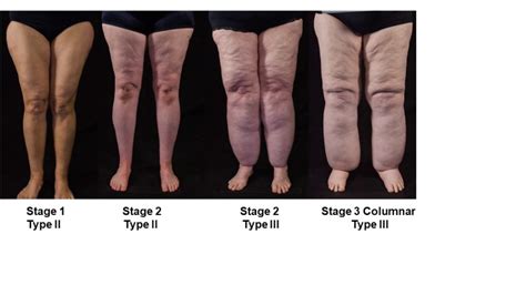 Figure 2. [Three stages of legs of...]. - Endotext - NCBI Bookshelf