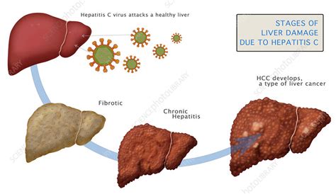 Hepatitis C Liver Disease