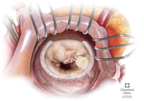 Techniques for Mitral Valve Re-repair - Operative Techniques in ...