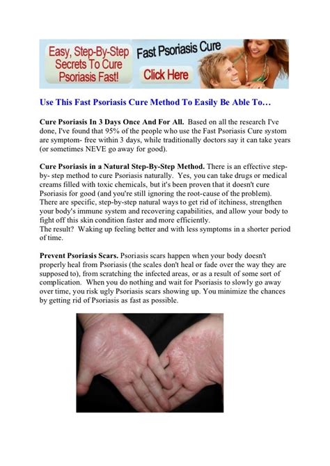 psoriasis home remedies - natural remedies for psoriasis - home remed…