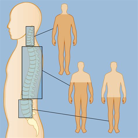 Spinal Cord Injuries | Weill Cornell Brain and Spine Center