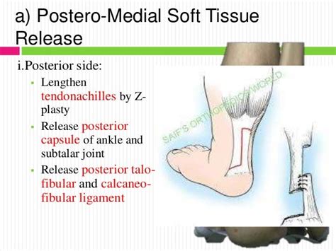 Mellss yr5 ortho treatment of congenital talipes equino varus (ctev)