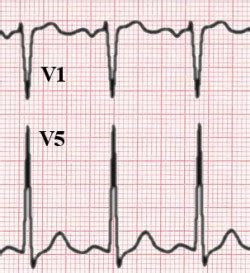 Left ventricular hypertrophy electrocardiogram - wikidoc