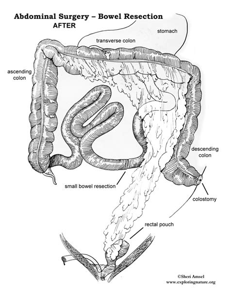 Abdominal Surgery - Bowel Resection