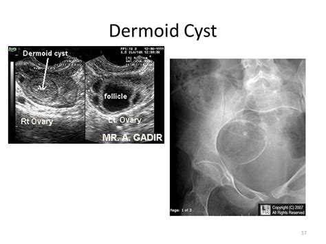 Excision of dermoid cyst: Dermoid Cyst Treatment & Management: Surgical ...