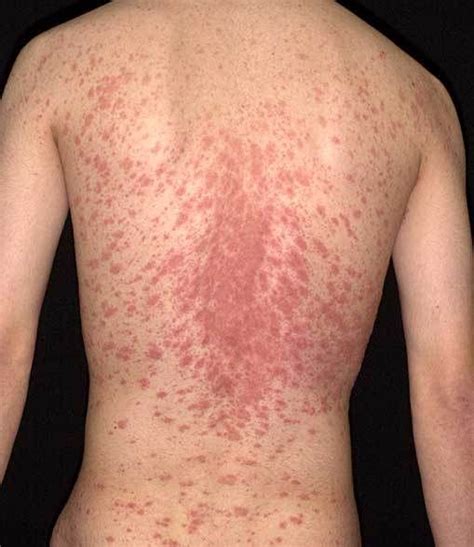 pityriasis rosea skin rash photos - Christmas Tree Distribution ...