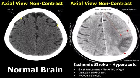 CT Scan Brain Normal Vs Ischemic Stroke Images | Non-Contrast ...