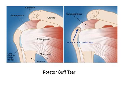 Supraspinatus Muscle Tear