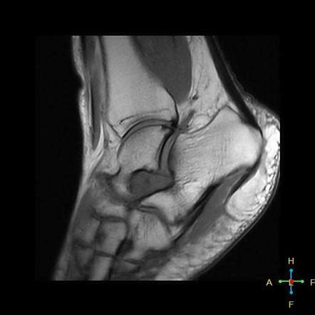 Sinus tarsi syndrome | Radiology Reference Article | Radiopaedia.org