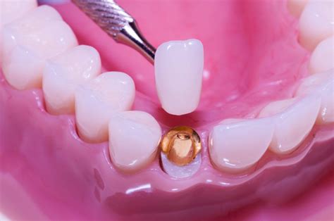 Porcelain Crowns - A Great Way To Restore A Beautiful Smile - Heritage Park Dental- Dentist in ...