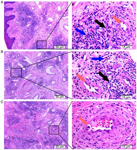 Rare angiolymphoid hyperplasia with eosinophilia examined through fine needle aspiration ...