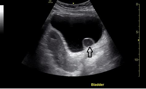 Cureus | Ureterocele Diagnosed With Point-of-Care Ultrasound