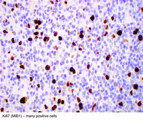 Pathology Outlines - Anaplastic oligodendroglioma, IDH-mutant and 1p / 19q-codeleted