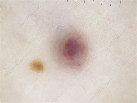 Glomangioma, dermoscopy - Stock Image - C056/0947 - Science Photo Library