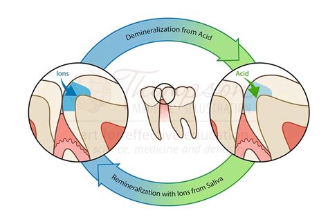 Demineralization/Remineralization Cycle Illustration by Thompson ...