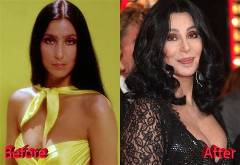 Cher Plastic Surgery : Just Too Much Of Procedures